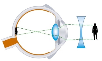 Oeil myopie corrigé