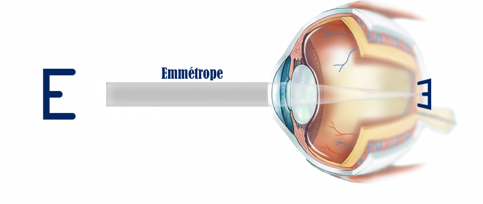 oeil émmétrope