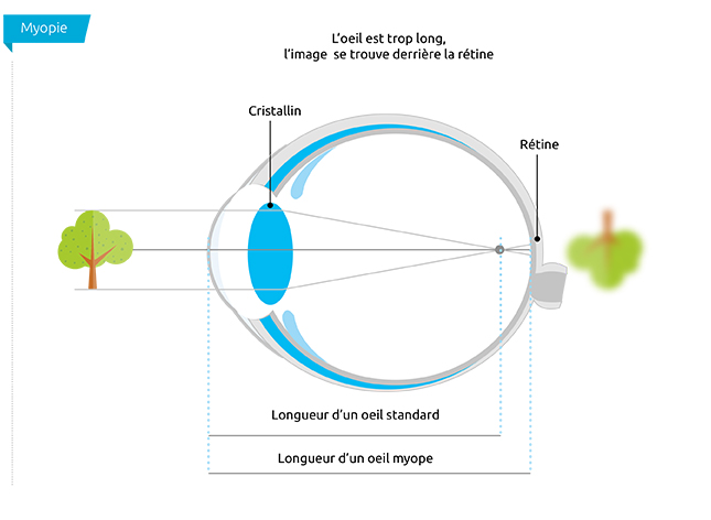 Oeil myope