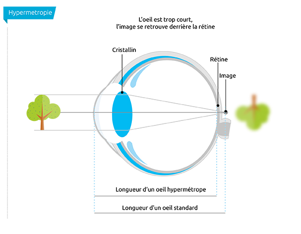 L'œil hypermétrope