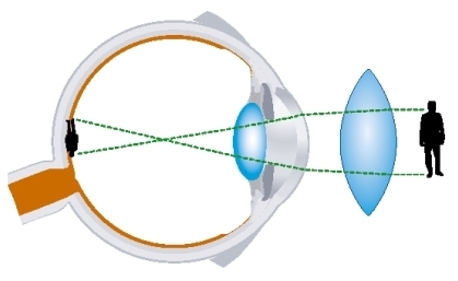 Le verre convexe pour l'hypermétropie